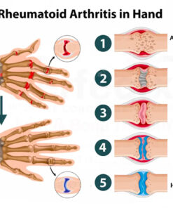 CroAie™ Perfeᴄtx Joint & Bone Therapy Cream